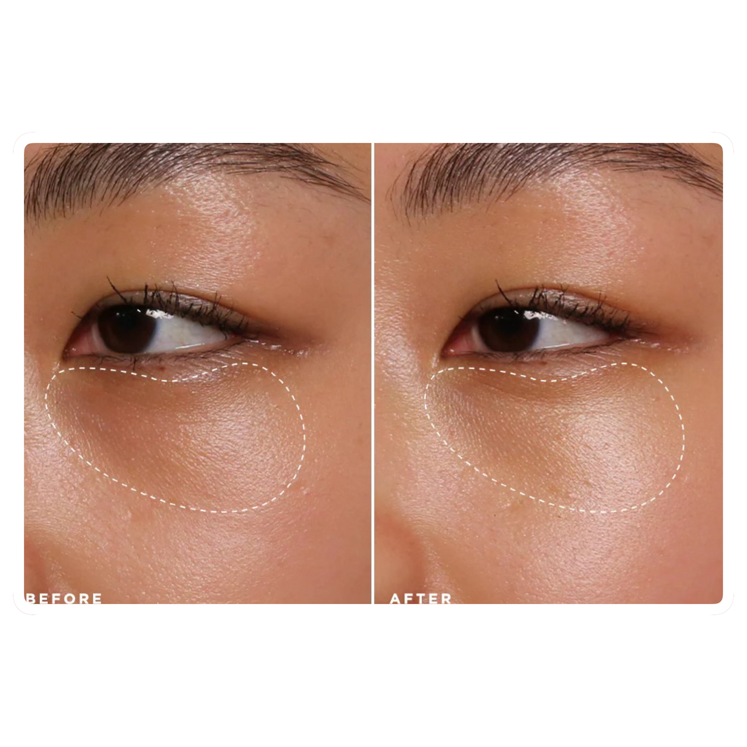 What Causes Dark Under-Eyes and How to Effectively Treat It