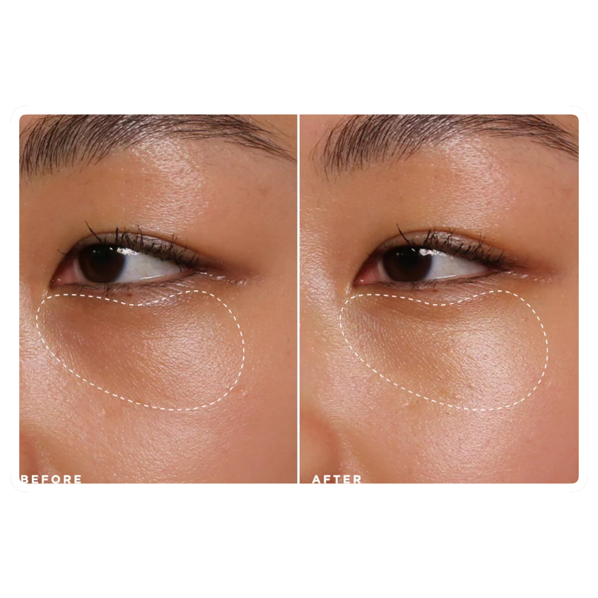 What Causes Dark Under-Eyes and How to Effectively Treat It