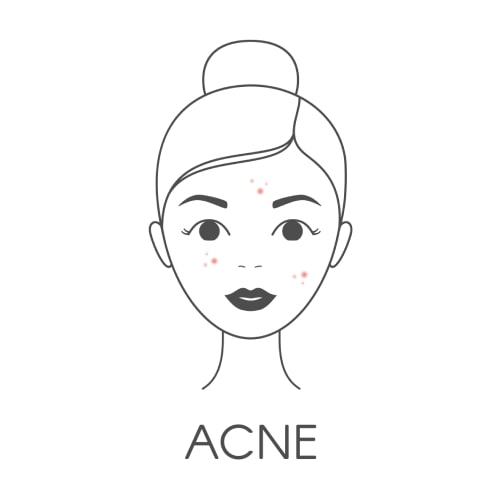 Acne Prone Skin