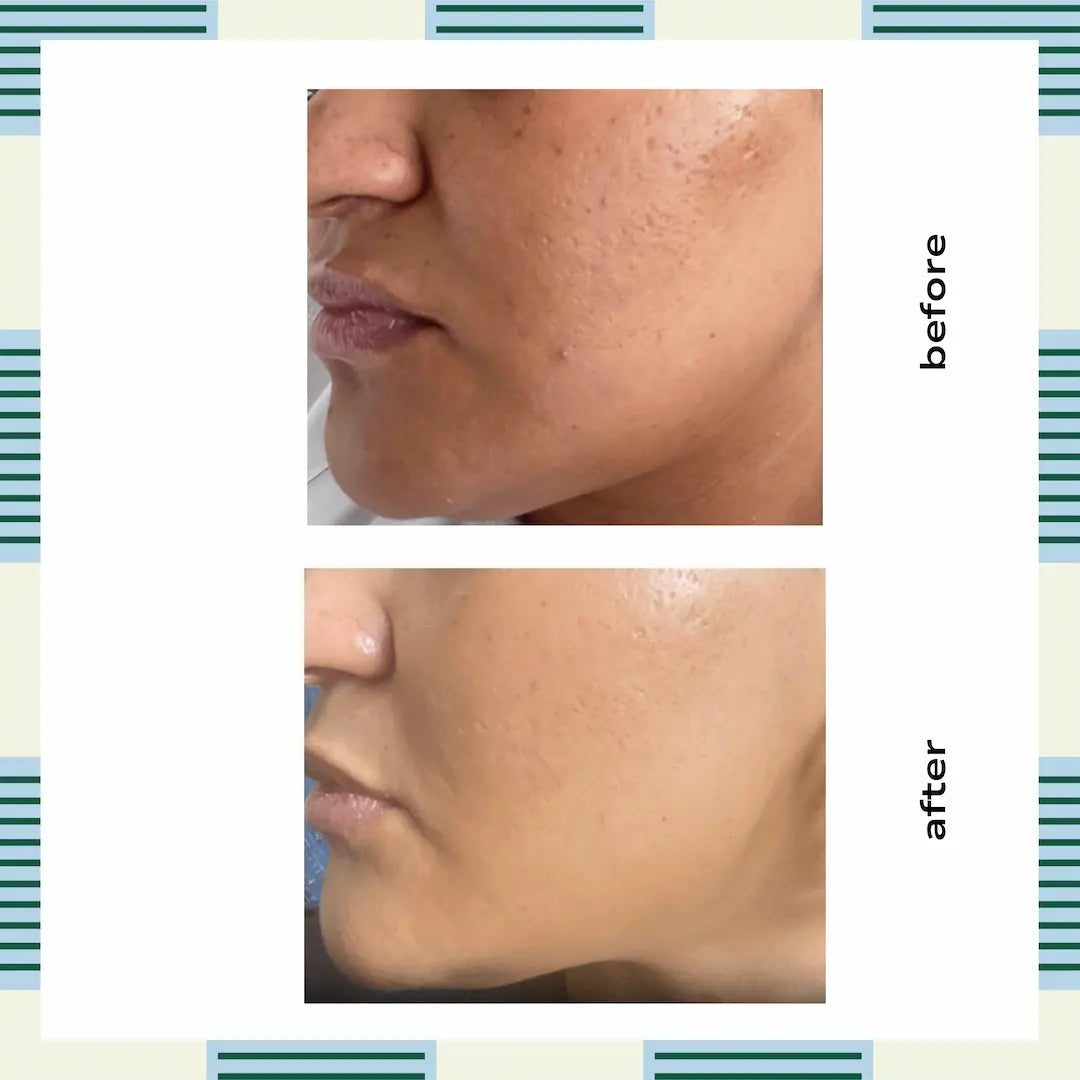 2 Step Triple Acid Peel At-Home Facial Kit