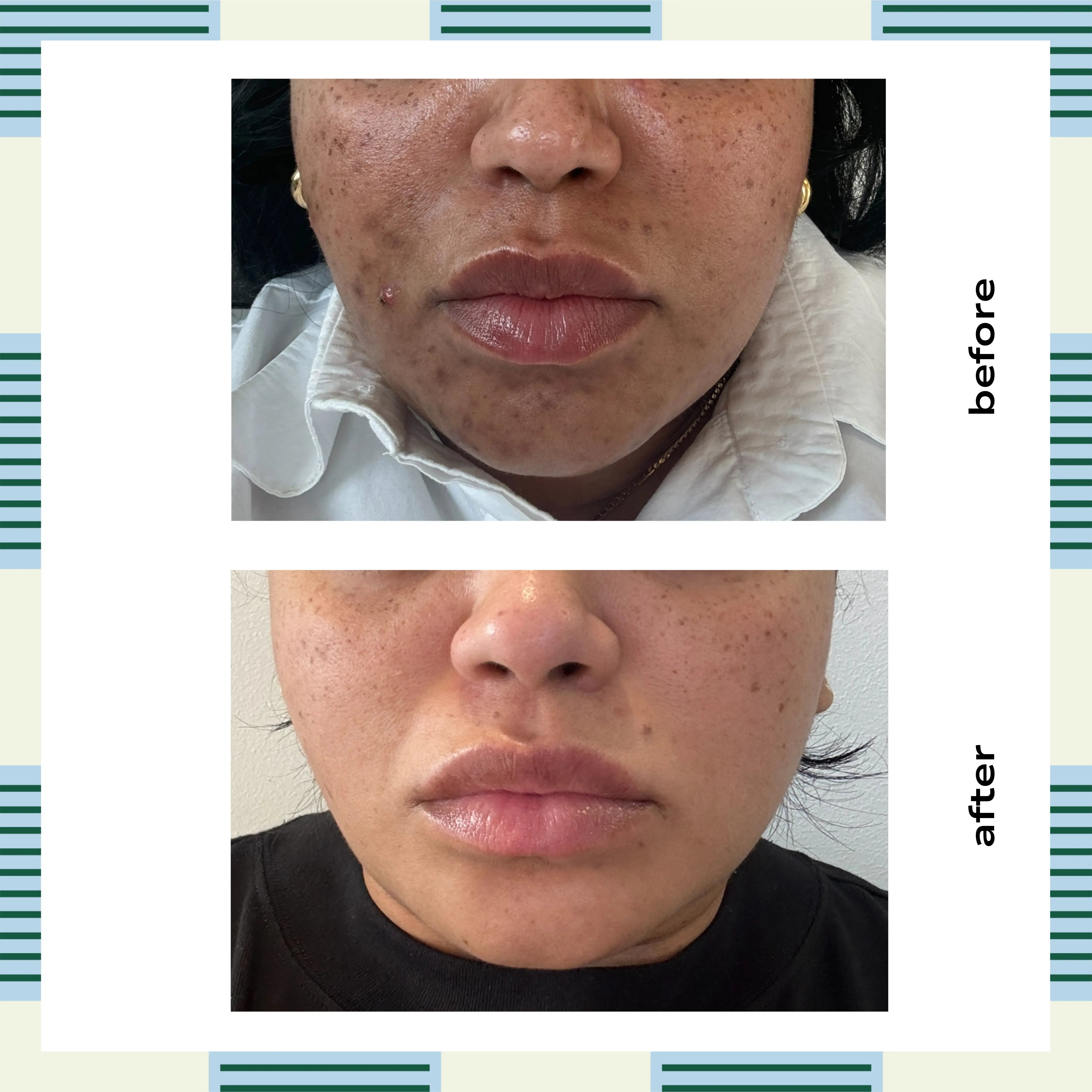 Glutathione Dark Mark Serum, 30 ml