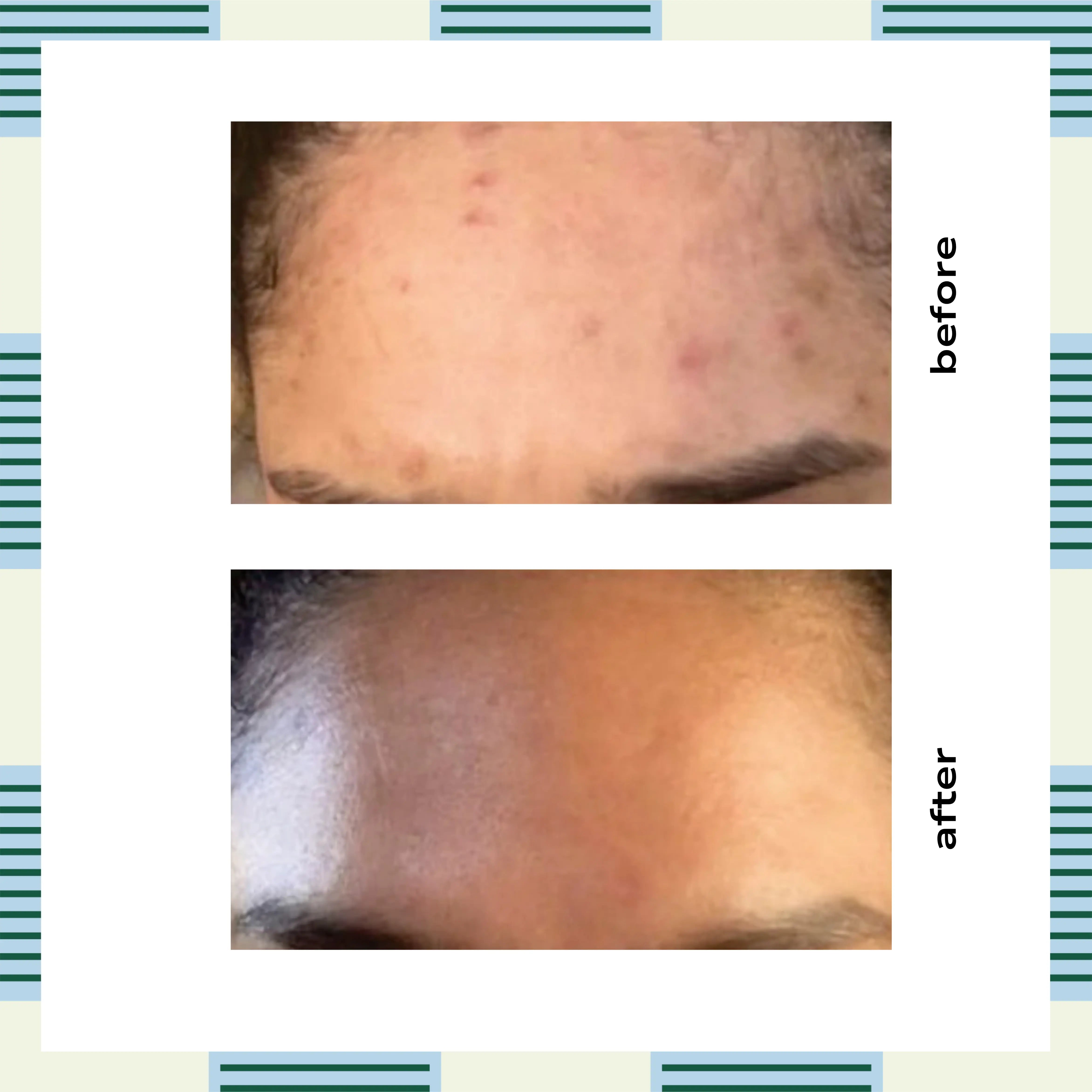 Bye Bye Breakouts | 3-Step Facial Kit