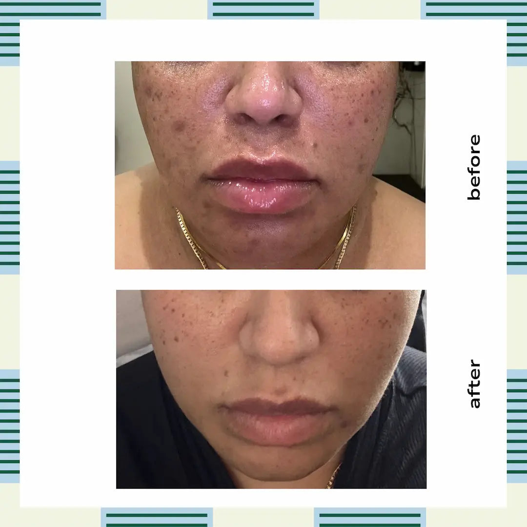 Kojic Acid Dark Mark Serum, 30 ml