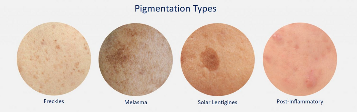 Target Hyperpigmentation and Reclaim Your Radiant Glow