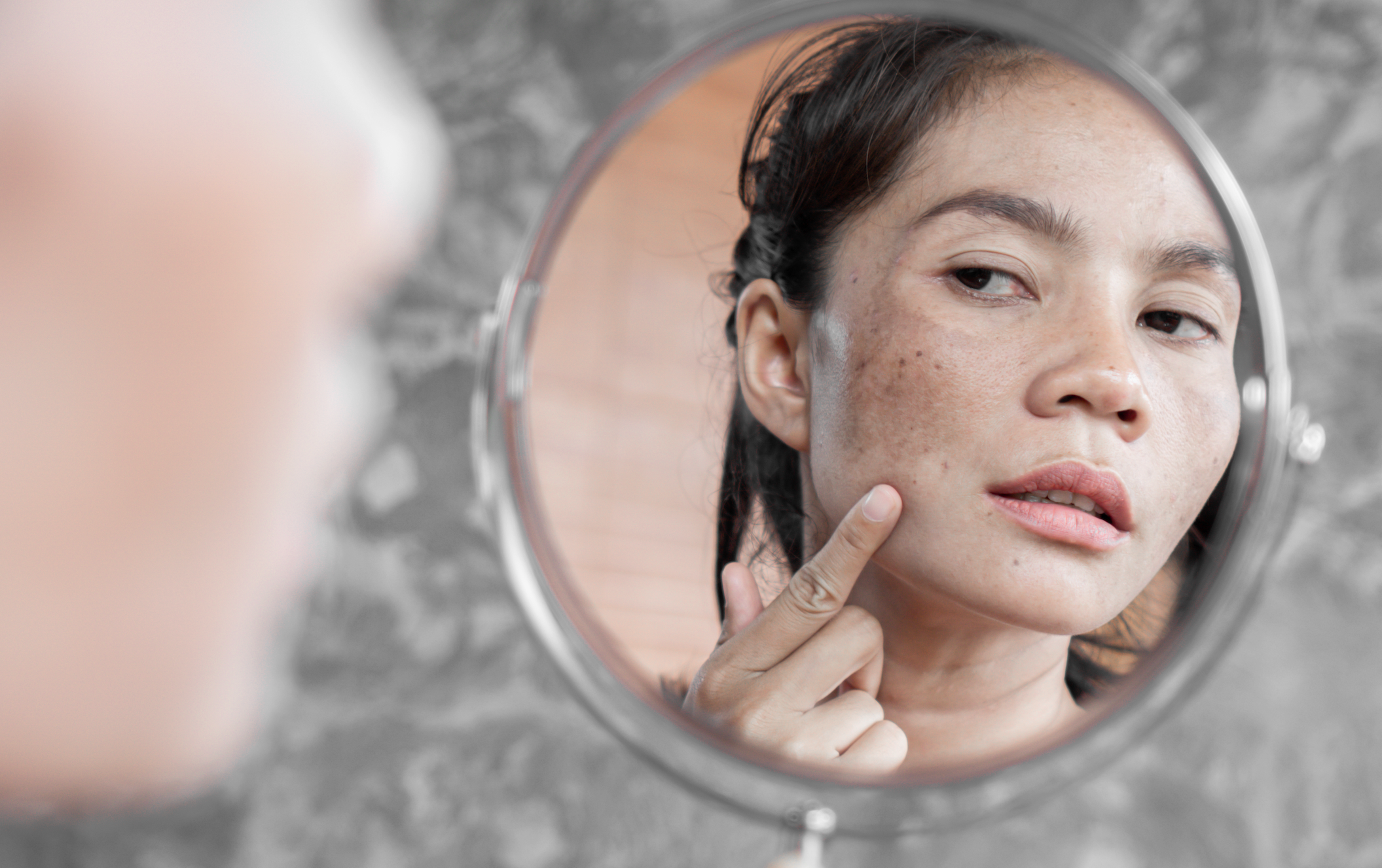 3 ways to minimise scarring & hyperpigmentation | YEARN SKIN