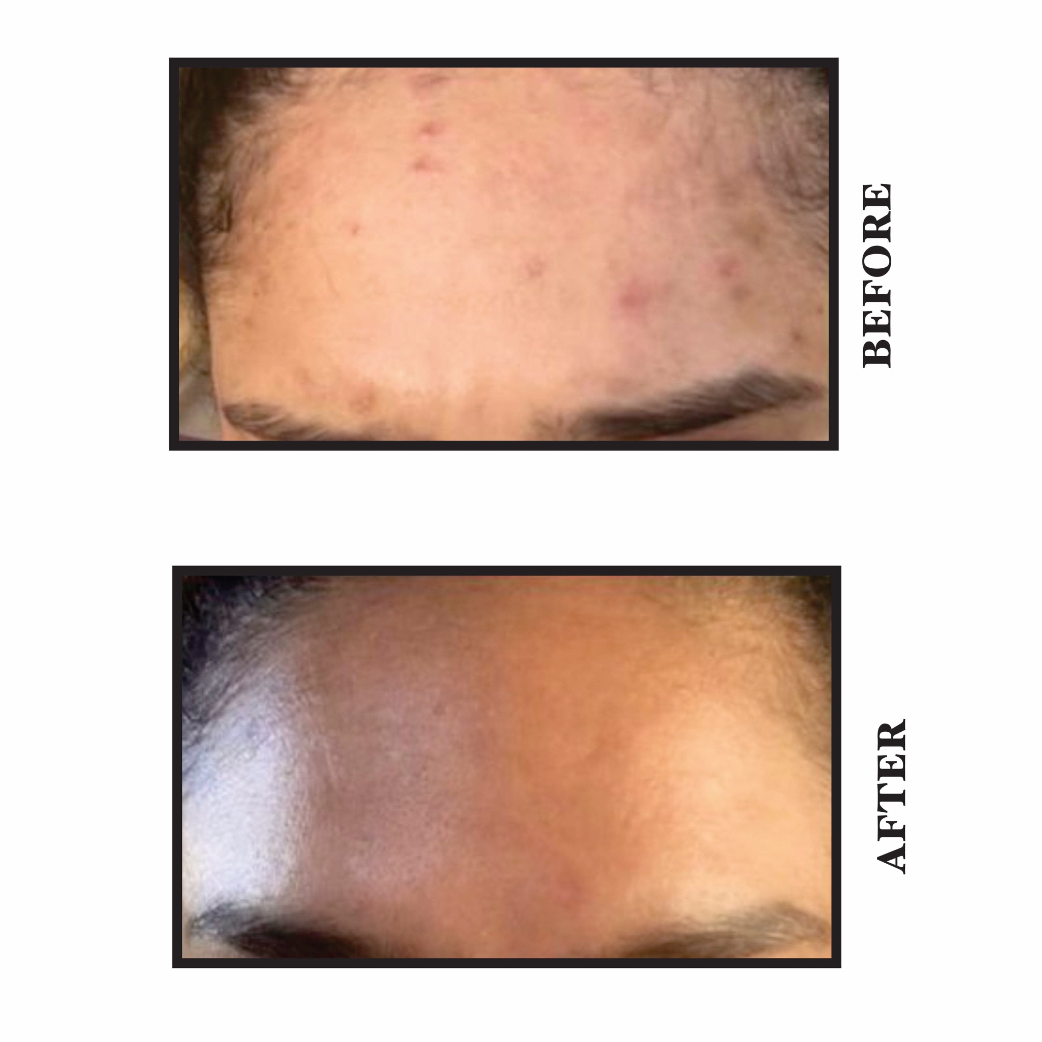 Salicylic Cleansing Gel before & after - Shop Online | yearnskin.co.za